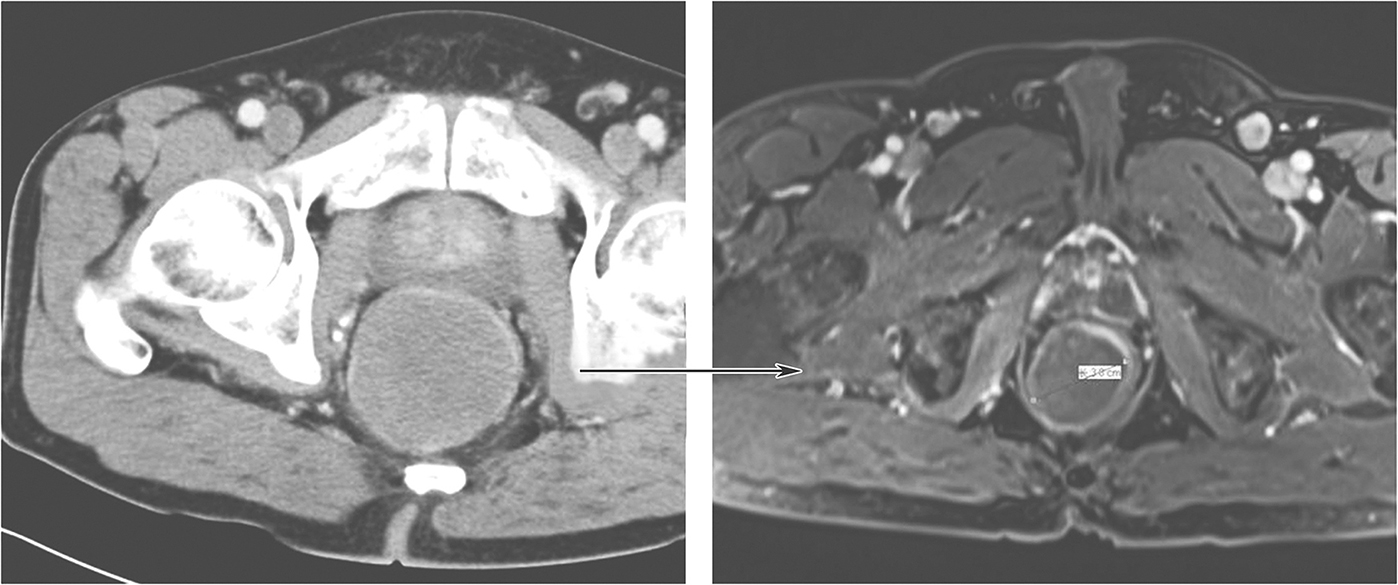 图3 伊马替尼治疗8个月后复查增强MRI.jpg